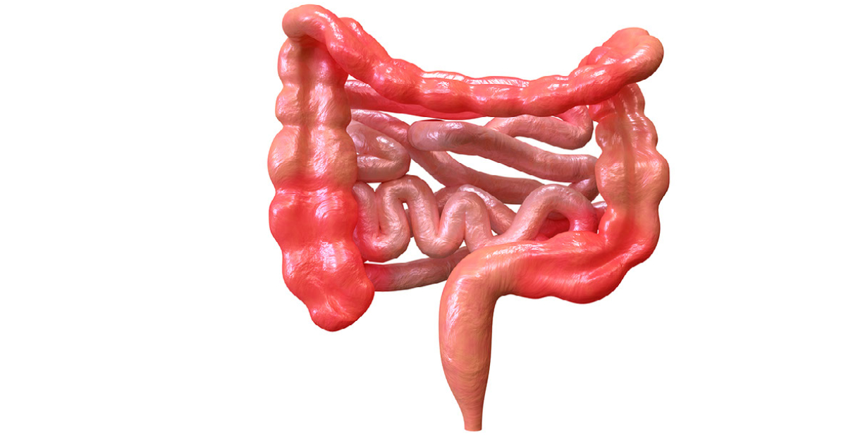 Crohns Disease - 1200