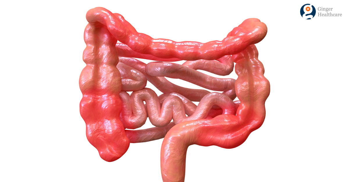 Crohn's Disease Causes, Symptoms, Diagnosis & Treatment