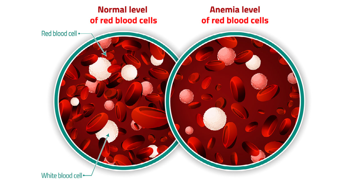 MyGov Manipur - Anemia occurs when the number of healthy red blood cells or  hemoglobin in your body is too low. Hemoglobin is a central part of red  blood cells. Red blood