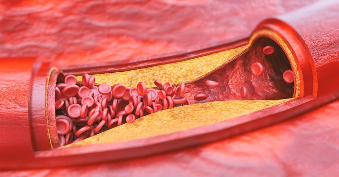 Atherosclerosis: Causes, Symptoms, Diagnosis, Treatment, Risk Factors ...