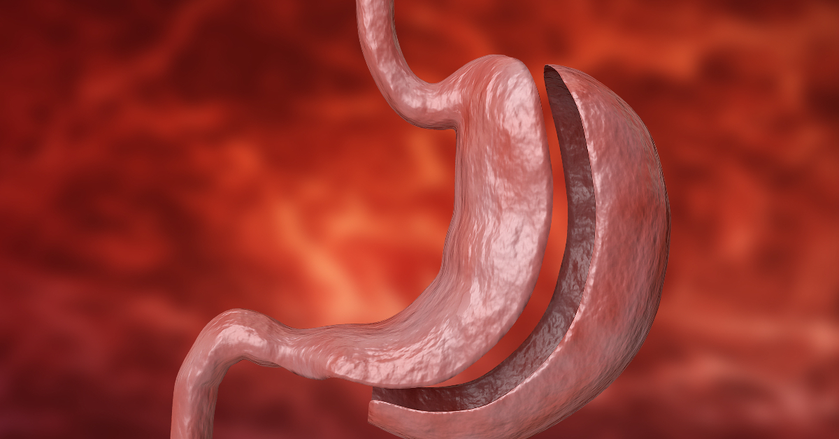 Bariatric Surgery Types Causes Guidelines Evaluation Pre Requisites Risks Complications