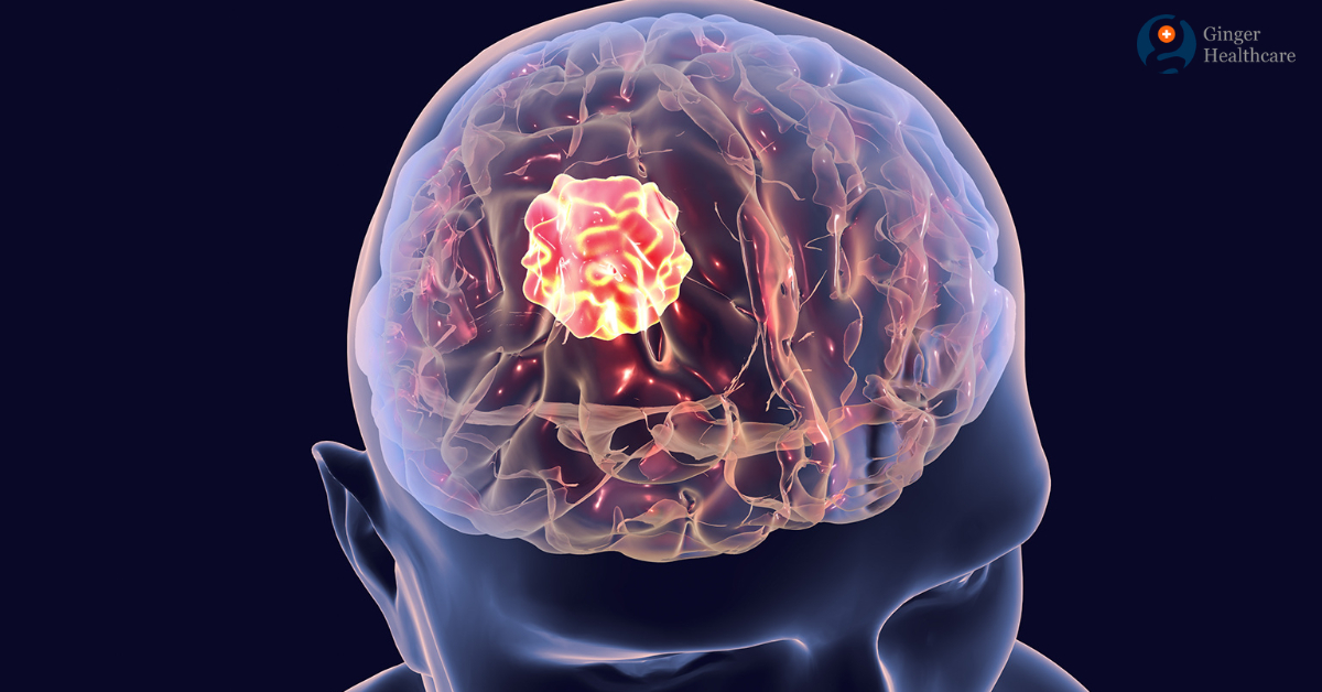Gliomas brain tumor