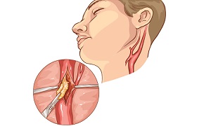 Carotid Endarterectomy Image