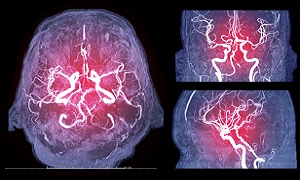 Cerebral Angiogram Image