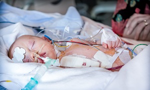 Child After Heart Surgery Image