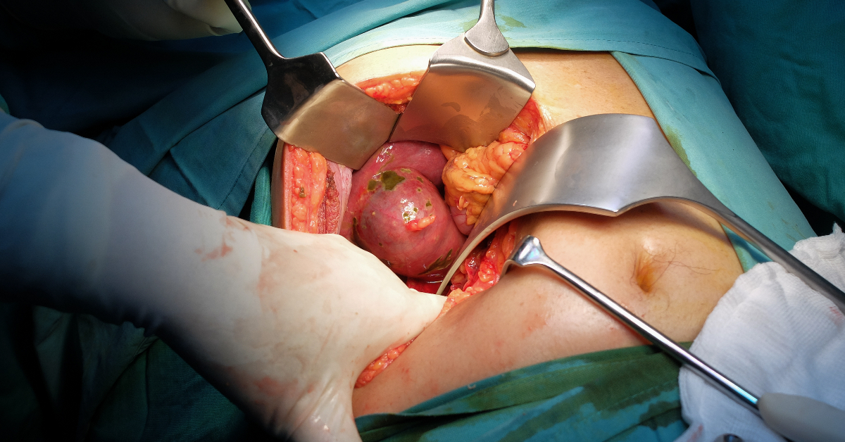 Cholecystectomy Image