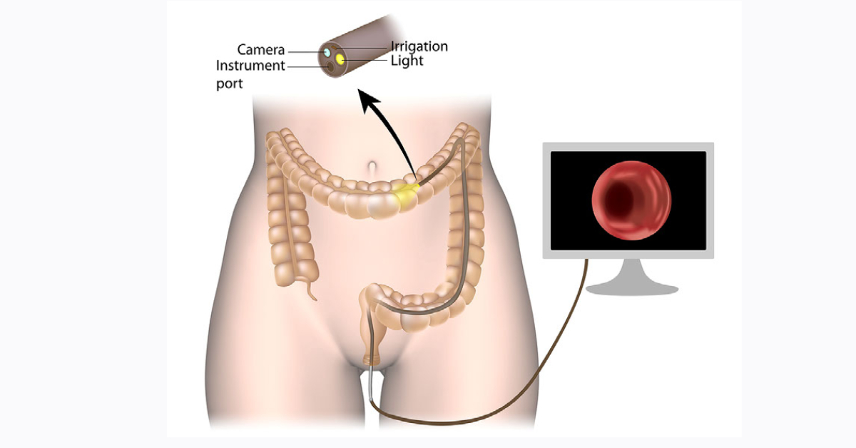 SNS - Sacral Nerve Stimulation image
