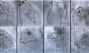 Coronary Angiography Image 1