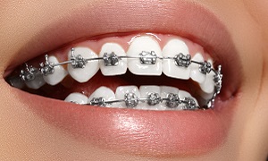 Dental Braces Image