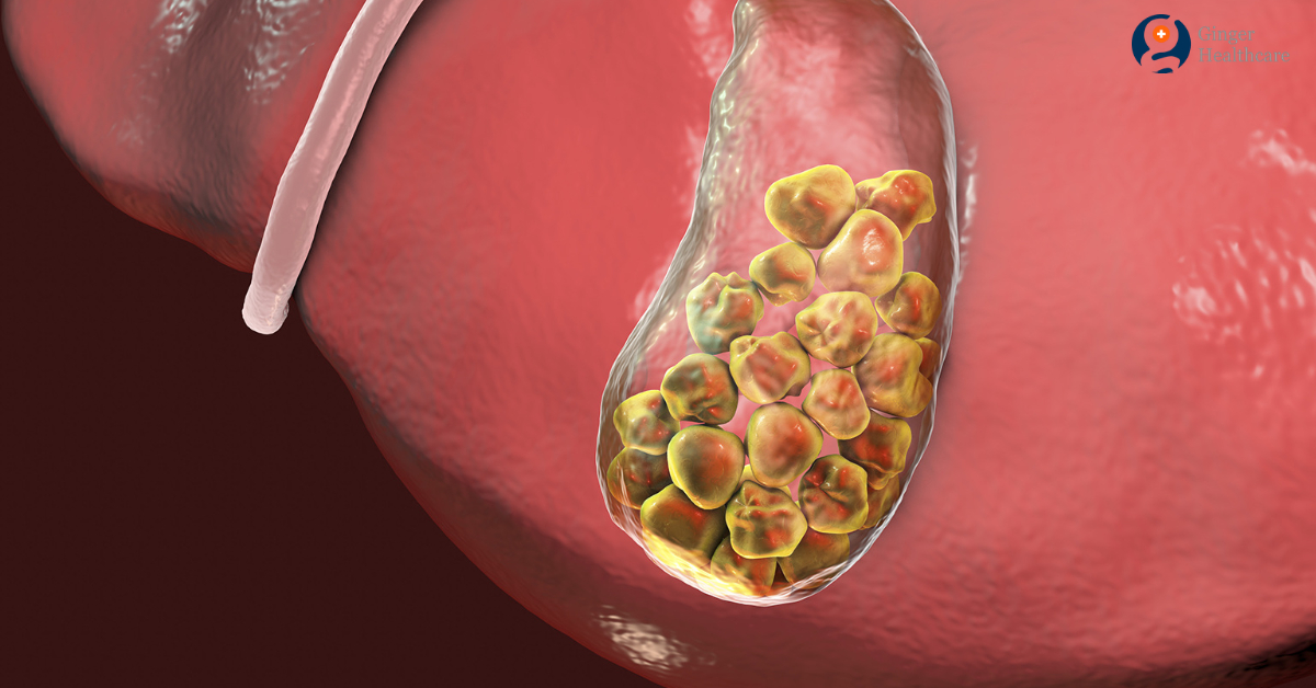 gallstones