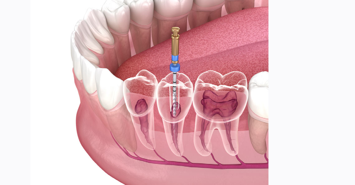 Root Canal image