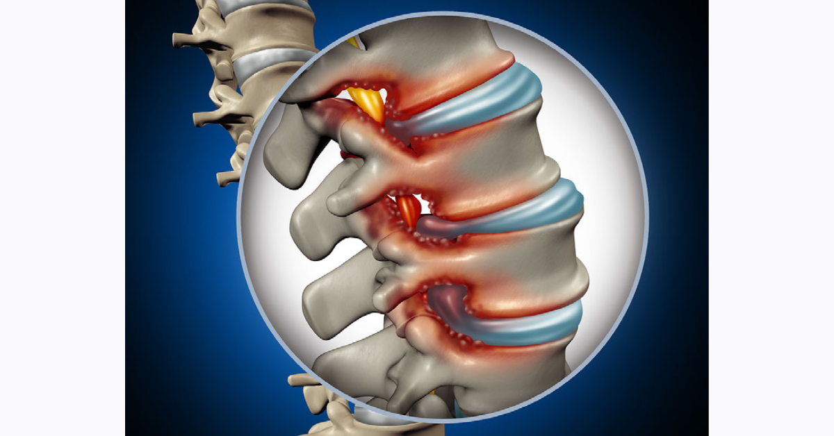 Spinal Stenosis image