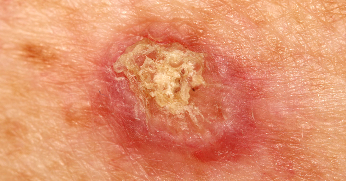 Squamous Cell Carcinoma Causes Symptoms Prevention Diagnosis