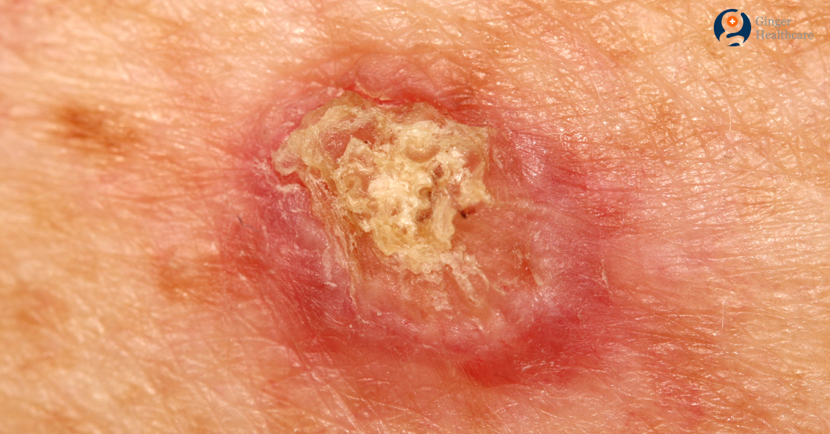 Squamous Cell Carcinoma