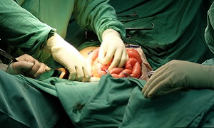 Surgery Colectomy Image