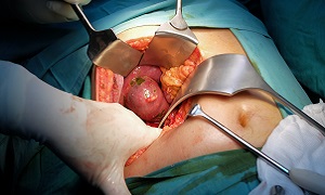 Surgery Image - Cholecystectomy
