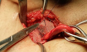 Surgery Open Inguinal Hernia Repair Image