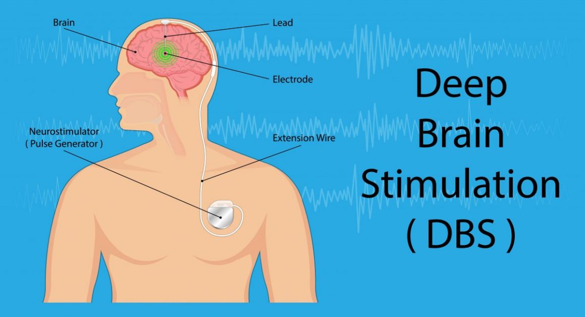 Deep Brain Stimulation (DBS) - 1200