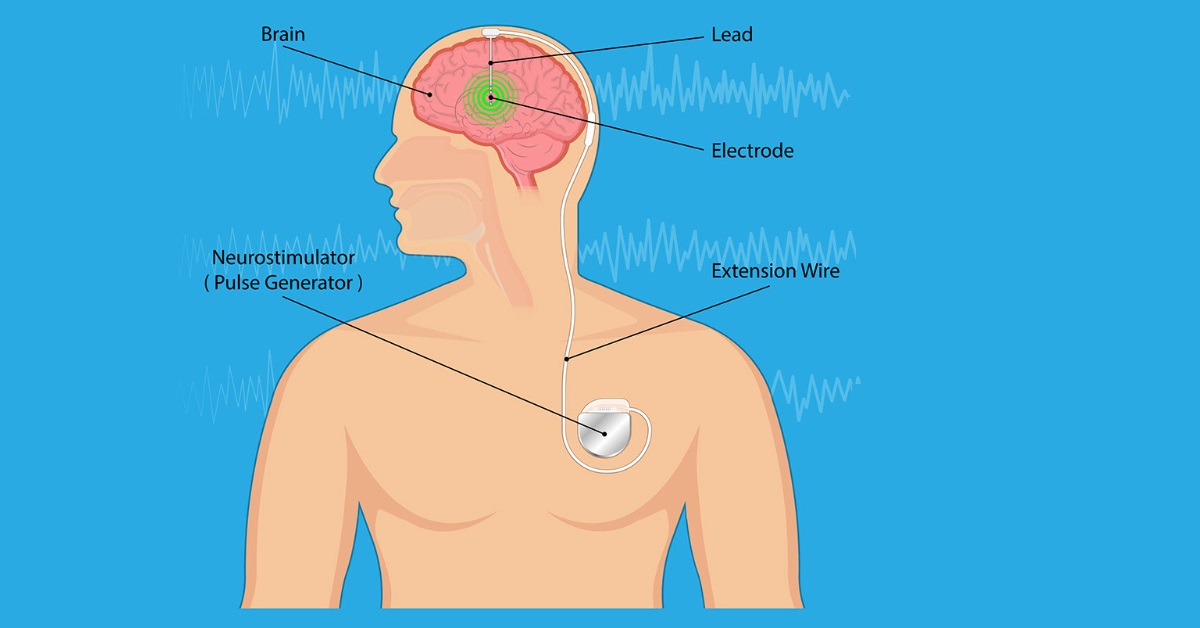 Deep Brain Stimulation (DBS) Image