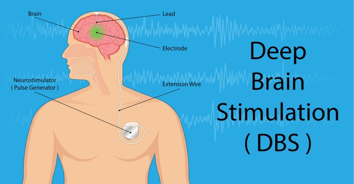 Deep Brain Stimulation Purpose Preparation Procedure Advantages And Risks 