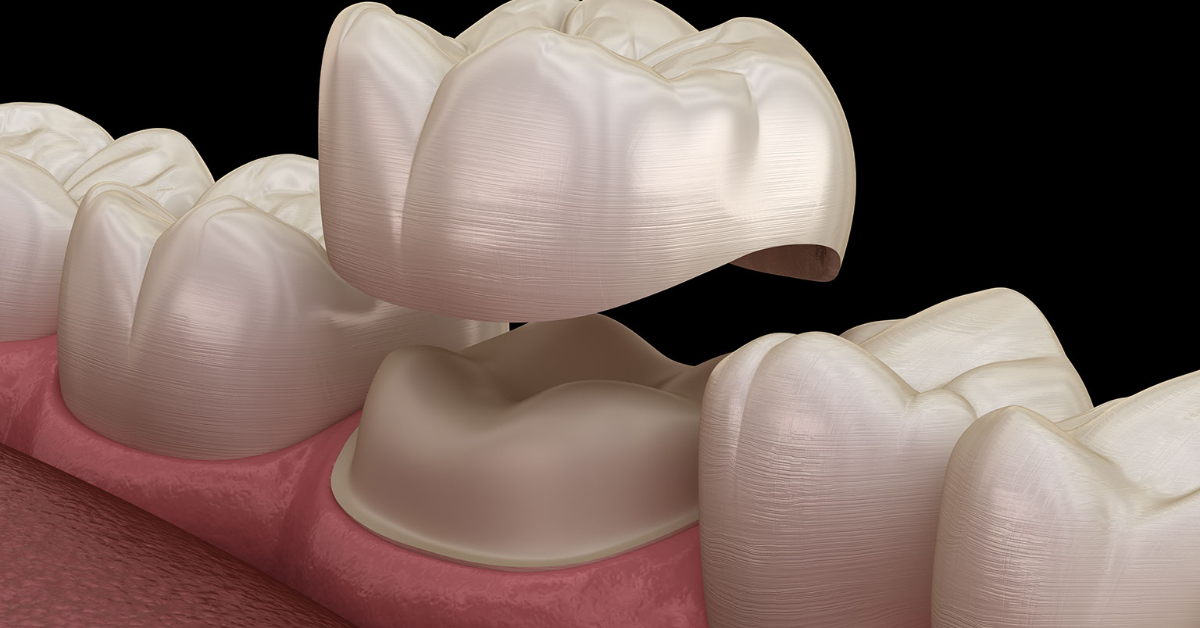 Dental Crown image