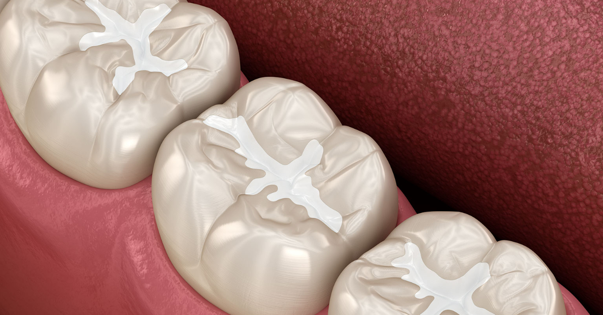 Dental Sealant image