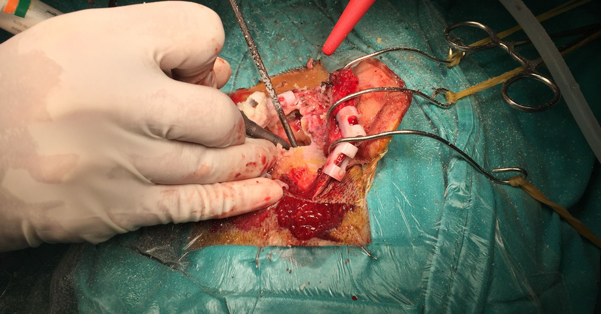 Mastoidectomy image