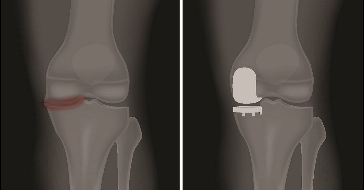 Partial knee Replacement - 1200