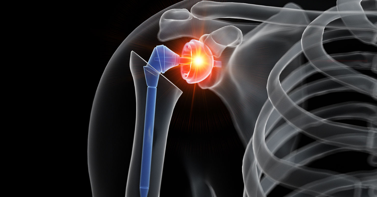 Shoulder Replacement Surgery - 1200