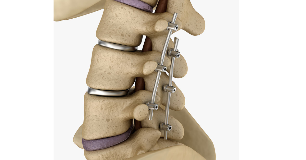 Spinal fusion image