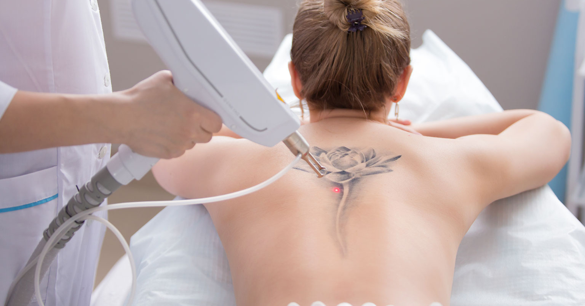Tattoo Removal image