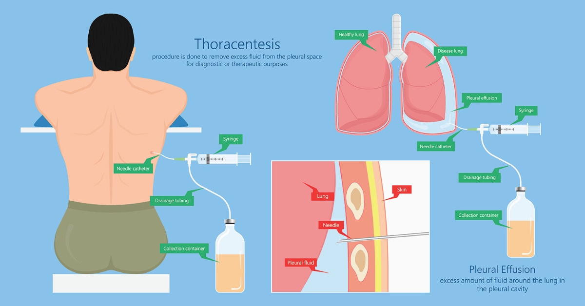 Thoracentesis Anatomy