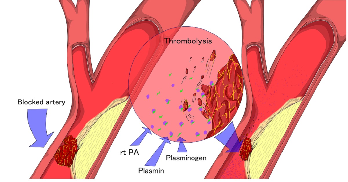 Thrombolysis image