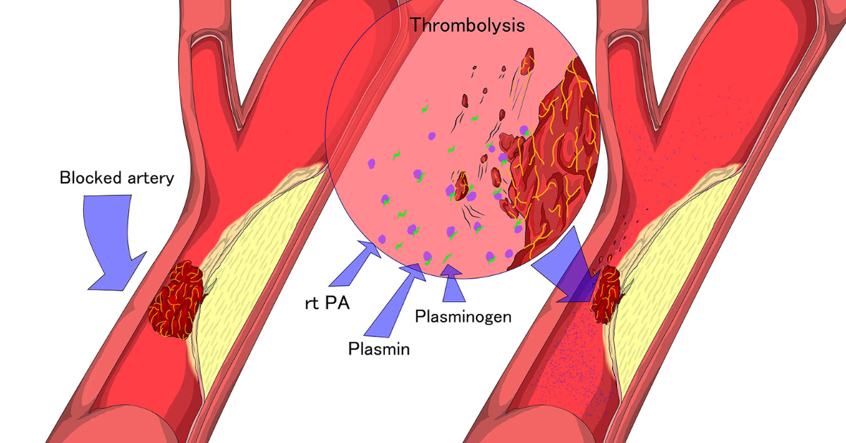 Thrombolysis: Purpose, Preparation, Procedure, Aftercare & Risks