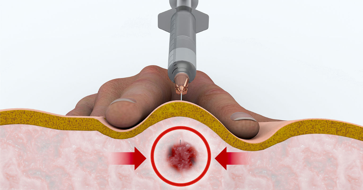 Trigger Point Injection image