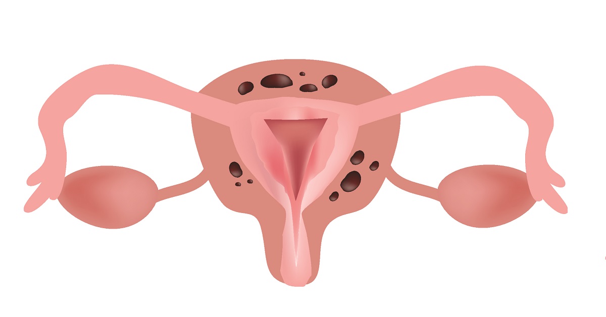 Endometrial Ablation image