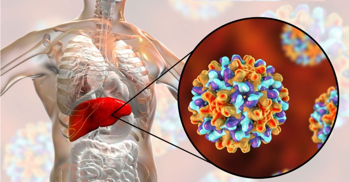 Alcoholic Hepatitis: Symptoms, Causes, Diagnosis, Treatment ...