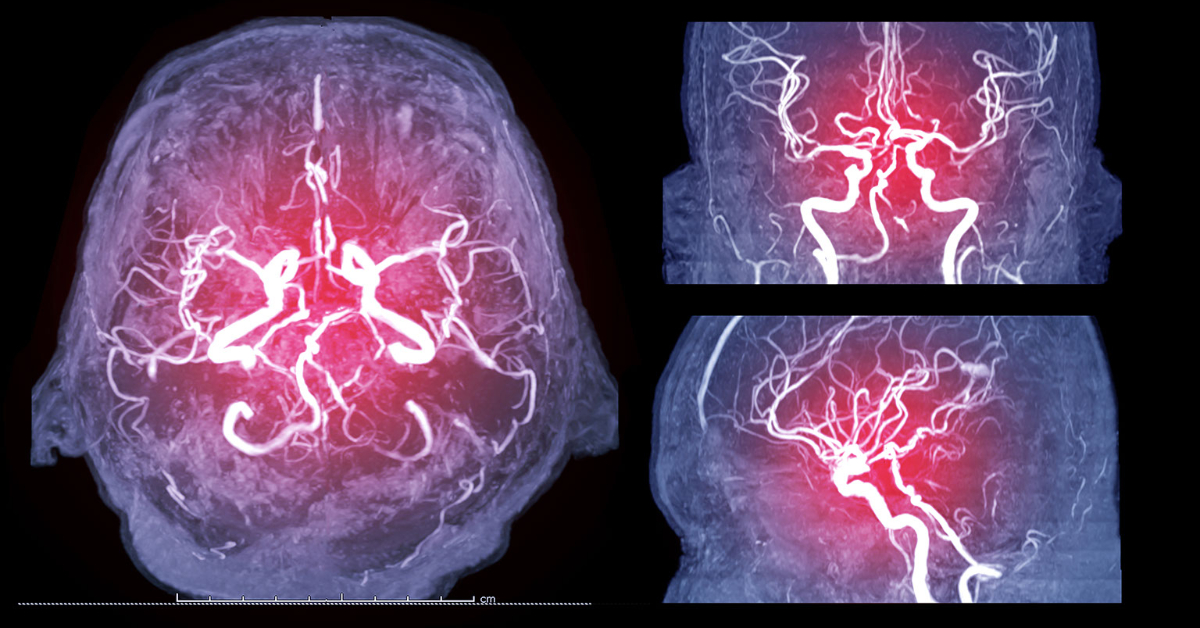 Cerebral Angiogram image