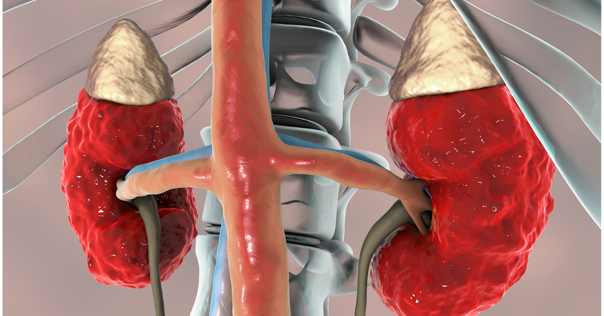 Polycystic Kidney image