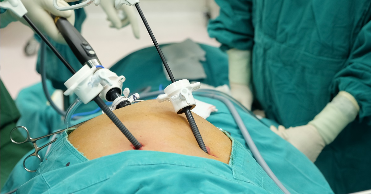 Cystectomy Image