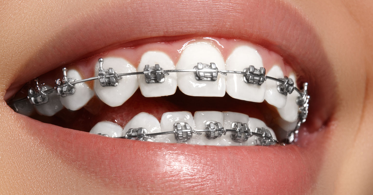Dental Braces image