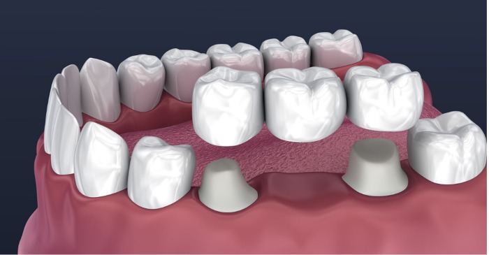 Зубной мост на 2 зуба фото