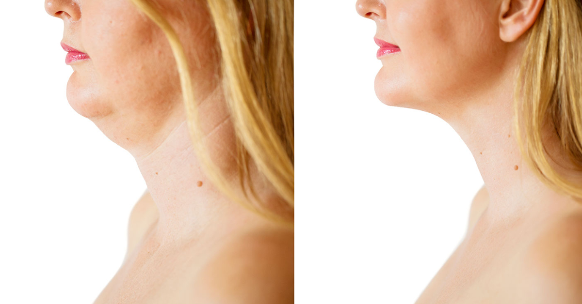Double Chin Removal image