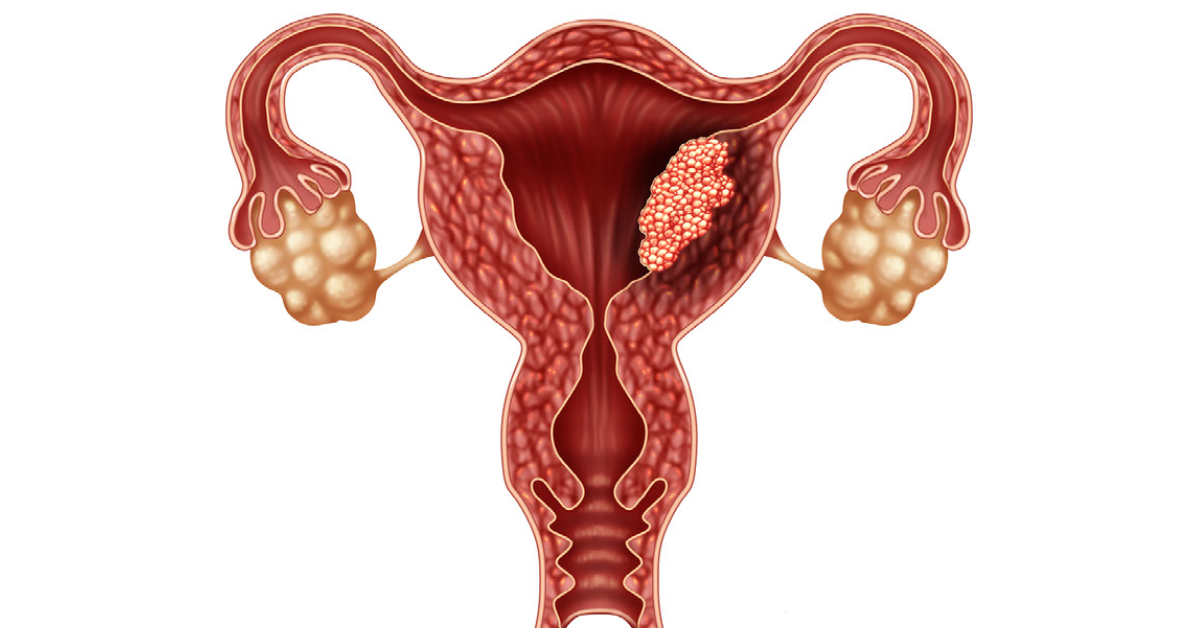Endometrial Cancer image