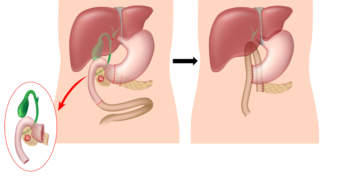 Pancreatectomy image