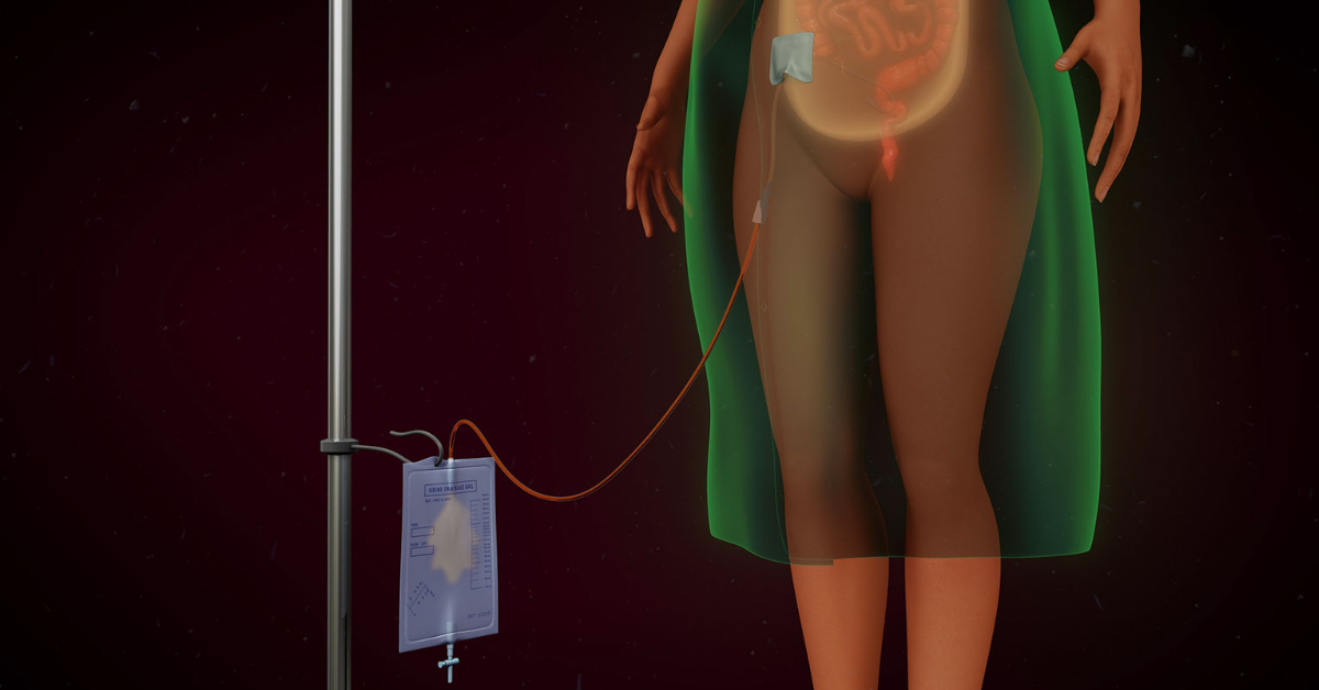 Peritoneal Dialysis image