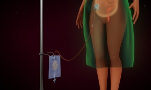 Peritoneal dialysis Image 1