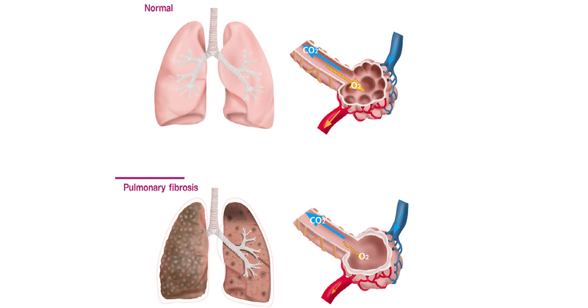 Pulmonary Fibrosis image