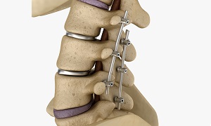 Spinal Decompression Image