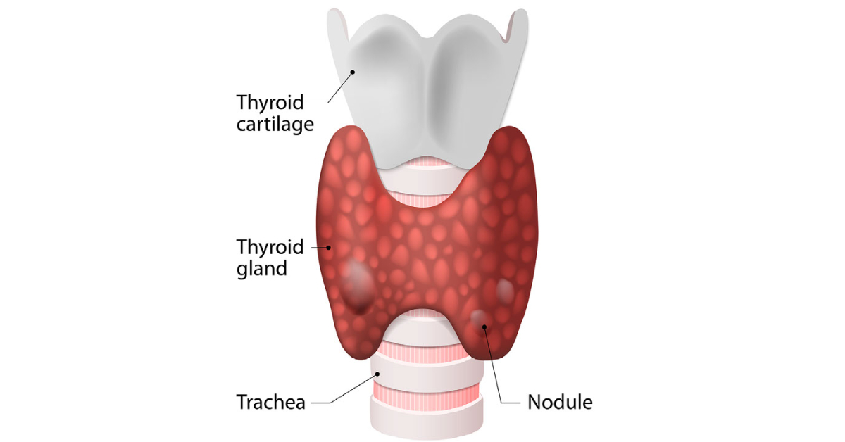 Thyroid Nodules image